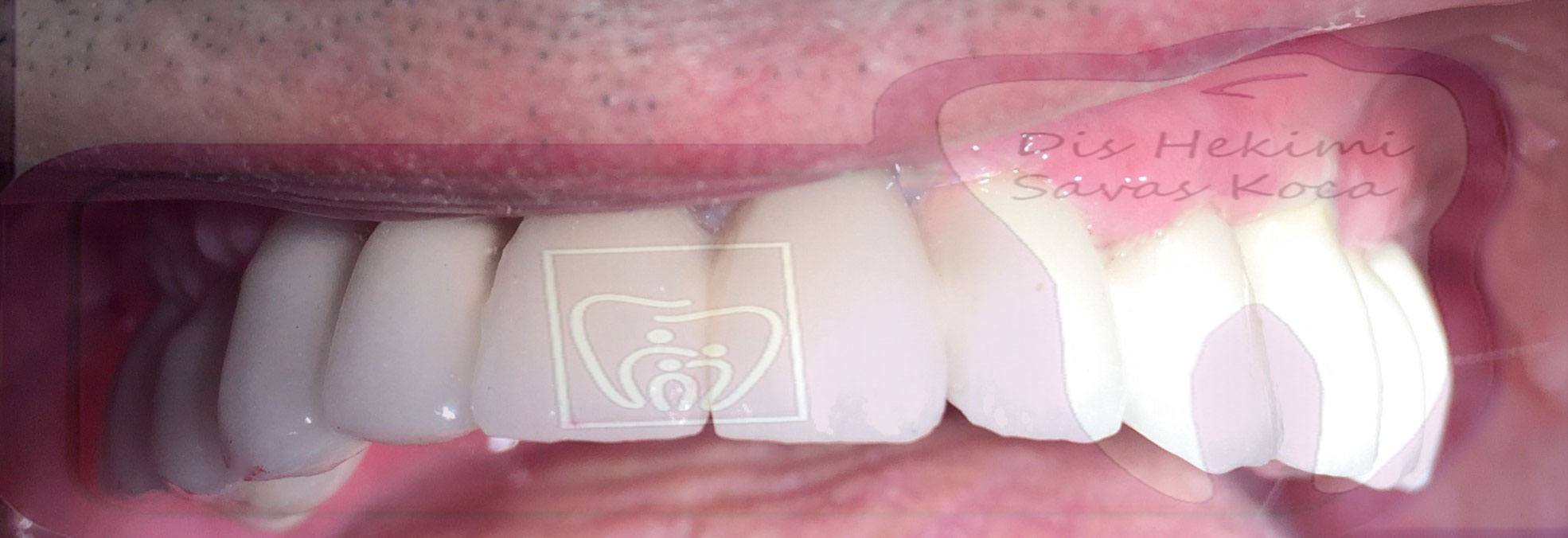 İmplant Simante Sistem Sonrası